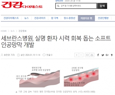 세브란스병원, 실명 환자 시력 회복 돕는 소프트 인공망막 개발
